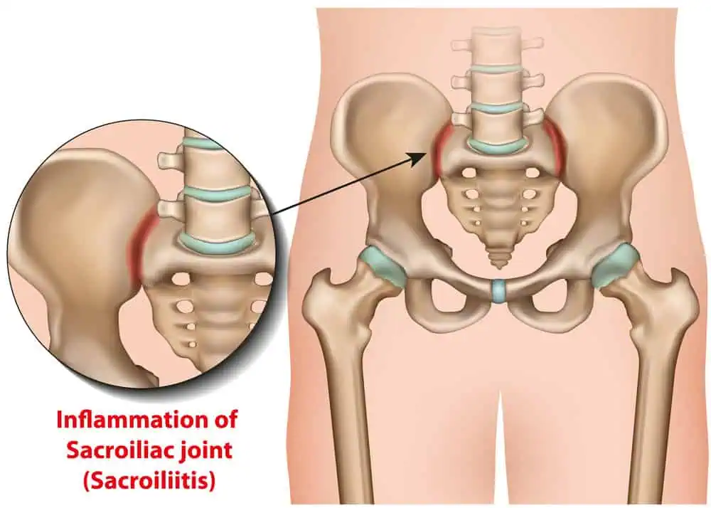 Sacroiliac joint injections