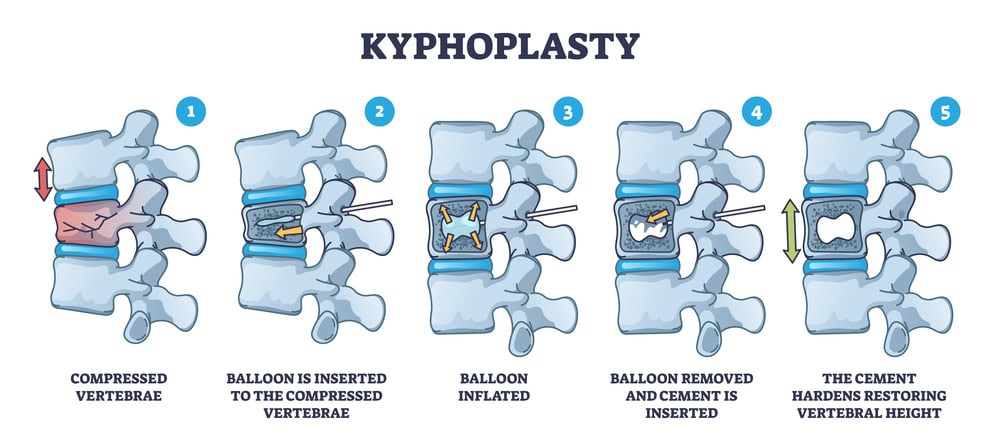 Vertebroplasty And Kyphoplasty Procedures: Innovative Solutions For 